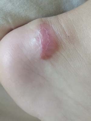 Scalped heel wound