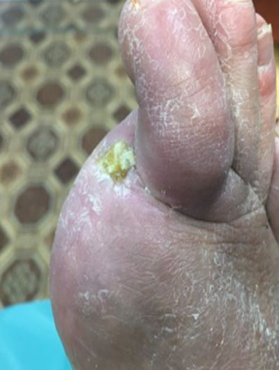 Diagnosis: Diabetes. Condition after amputation of the big toe of the right foot.