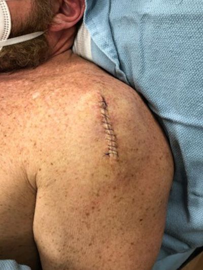 During surgery for the full-scale removal of cancer skin tumors (surgical stitch)