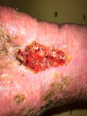 Trophic ulcer of the leg
