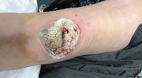 MIRRAGEN Monitor Progress: Inspect the wound regularly - every 3 to 7 days