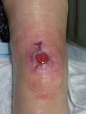 Пролежень. Ампутація нижче коліна, травма, пов'язана з протезом.