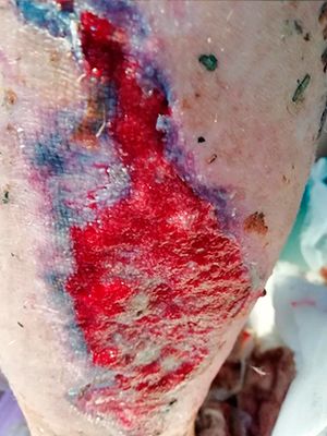 Extensive wound of the leg. Scalped wound of the lower leg due to an accident