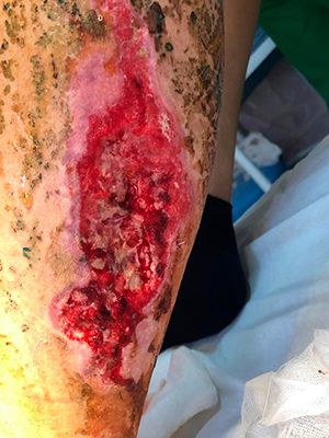 Обширная рана левой голени после ДТП