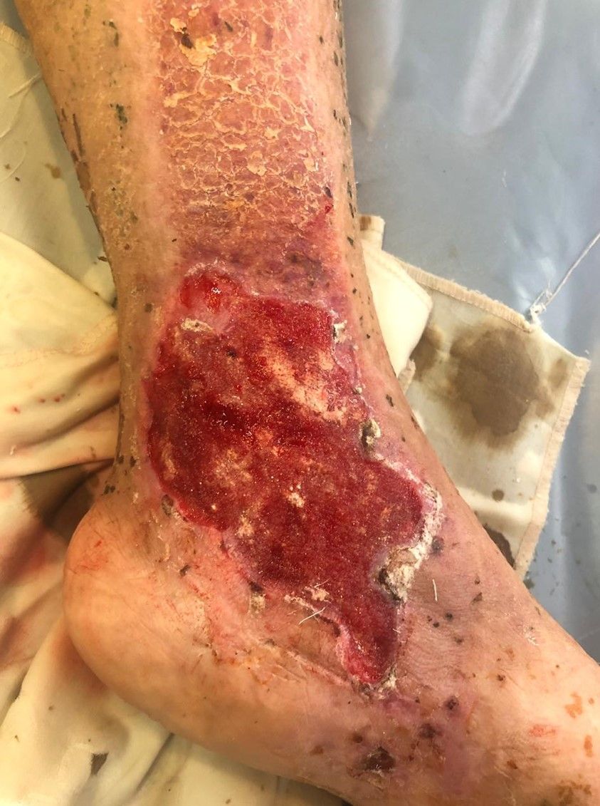 Extensive ankle wound. Laceration of the ankle due to an accident