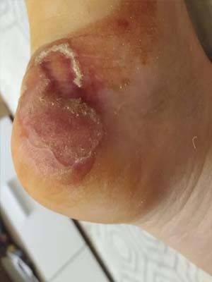 Scalped heel wound