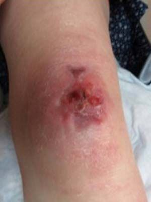 Пролежень. Ампутація нижче коліна, травма, пов'язана з протезом.