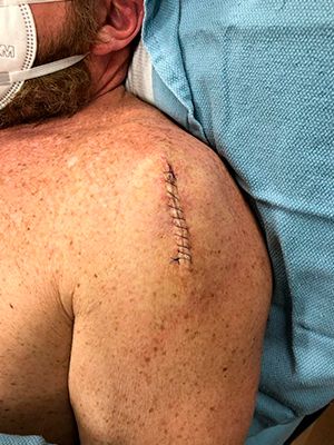 Suture, full-scale resection of suspected skin cancer