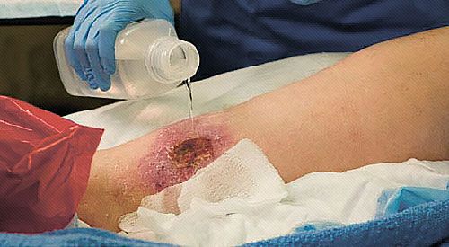 MIRRAGEN Dressing Changes: As with common practice, clean the wound with each dressing change