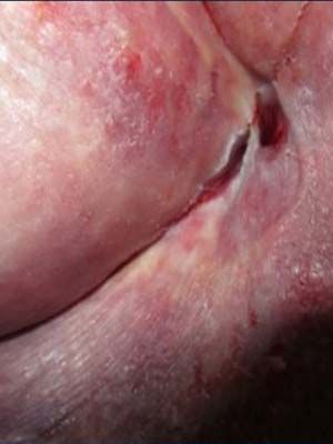 Ischial Ulcer