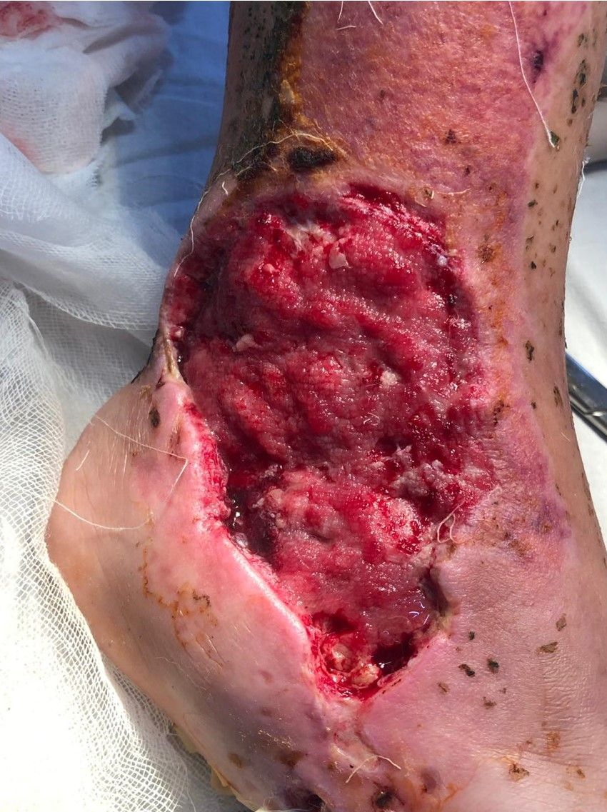 Extensive ankle wound. Laceration of the ankle due to an accident