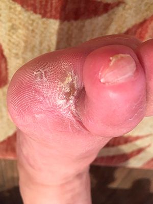 Diabetes. Condition after amputation of the big toe of the right foot